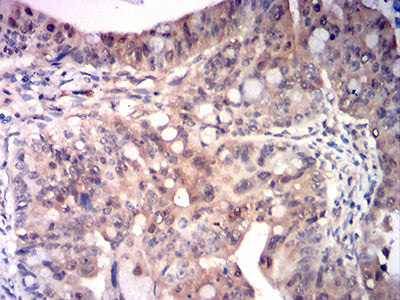 Figure 7: Immunohistochemical analysis of paraffin-embedded rectum cancer tissues using RRM1 mouse mAb with DAB staining.