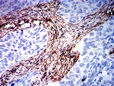 Figure 6: Immunohistochemical analysis of paraffin-embedded cervical cancer tissues using VIM mouse mAb with DAB staining.