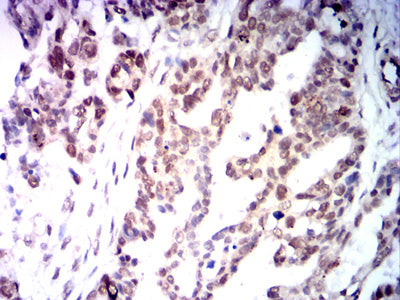 Figure 7: Immunohistochemical analysis of paraffin-embedded Ovarian cancer tissues using MLH1 mouse mAb with DAB staining.