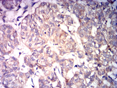 Figure 5: Immunohistochemical analysis of paraffin-embedded bladder cancer tissues using CCNE1 mouse mAb with DAB staining.