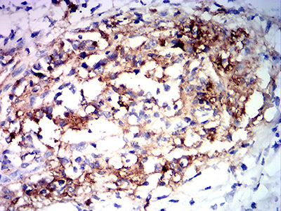 Figure 6: Immunohistochemical analysis of paraffin-embedded stomach cancer tissues using MUC2 mouse mAb with DAB staining.