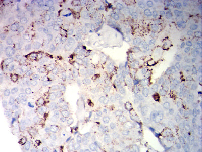 Figure 6: Immunohistochemical analysis of paraffin-embedded breast cancer tissues using NCAM1 mouse mAb with DAB staining.