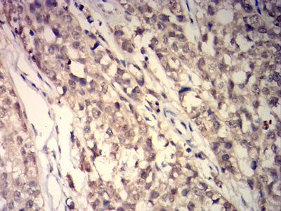 Figure 6: Immunohistochemical analysis of paraffin-embedded cervical cancer tissues using GSTP1 mouse mAb with DAB staining.