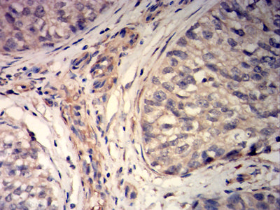 Figure 7: Immunohistochemical analysis of paraffin-embedded bladder Cancer tissues using MYLK mouse mAb with DAB staining.