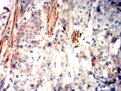 Figure 7: Immunohistochemical analysis of paraffin-embedded esophageal cancer tissues using HAS1 mouse mAb with DAB staining.