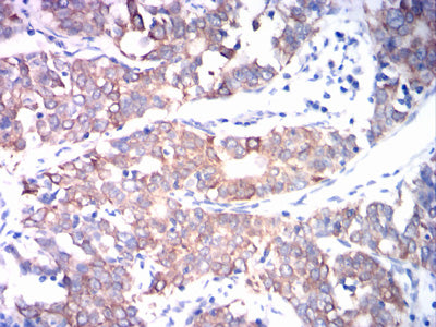 Figure 6: Immunohistochemical analysis of paraffin-embedded cervical cancer tissues using ADAM10 mouse mAb with DAB staining.