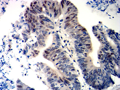 Figure 7: Immunohistochemical analysis of paraffin-embedded colon cancer tissues using WT1 mouse mAb with DAB staining.