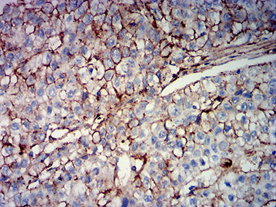 Figure 5: Immunohistochemical analysis of paraffin-embedded liver cancer tissues using MUC16 mouse mAb with DAB staining.