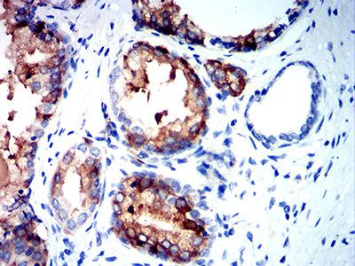 Figure 6: Immunohistochemical analysis of paraffin-embedded prostate cancer tissues using NEFH mouse mAb with DAB staining.