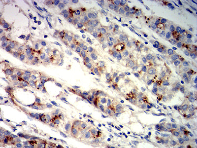 Figure 7: Immunohistochemical analysis of paraffin-embedded liver cancer tissues using GPC3 mouse mAb with DAB staining.