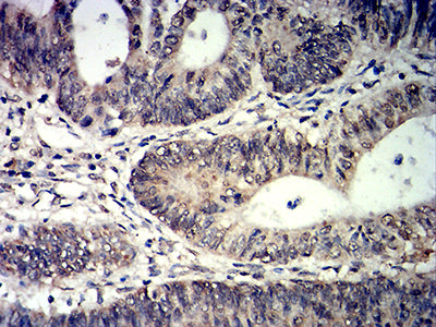 Figure 7: Immunohistochemical analysis of paraffin-embedded rectum cancer tissues using TET2 mouse mAb with DAB staining.