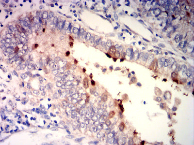 Figure 6: Immunohistochemical analysis of paraffin-embedded endometrial cancer tissues using SP17 mouse mAb with DAB staining.