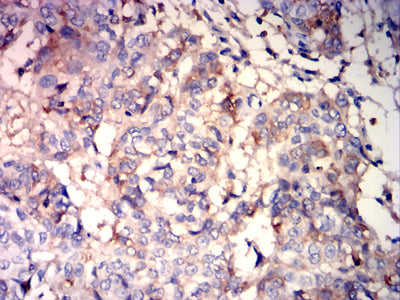 Figure 6: Immunohistochemical analysis of paraffin-embedded bladder cancer tissues using ALB mouse mAb with DAB staining.