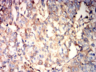 Figure 6: Immunohistochemical analysis of paraffin-embedded bladder cancer tissues using ALB mouse mAb with DAB staining.