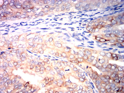 Figure 6: Immunohistochemical analysis of paraffin-embedded cervical cancer tissues using CD267 mouse mAb with DAB staining.