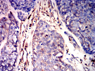 Figure 6: Immunohistochemical analysis of paraffin-embedded esophageal cancer tissues using GSN mouse mAb with DAB staining.