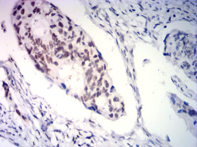 Figure 6: Immunohistochemical analysis of paraffin-embedded rectal cancer tissues using PGR mouse mAb with DAB staining.