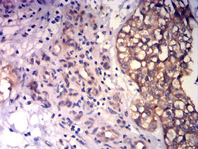 Figure 5: Immunohistochemical analysis of paraffin-embedded bladder cancer tissues using CD43 mouse mAb with DAB staining.