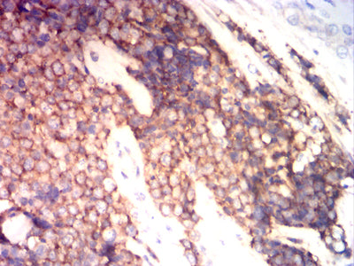 Figure 7: Immunohistochemical analysis of paraffin-embedded ewing sarcoma tissues using CD99 mouse mAb with DAB staining.