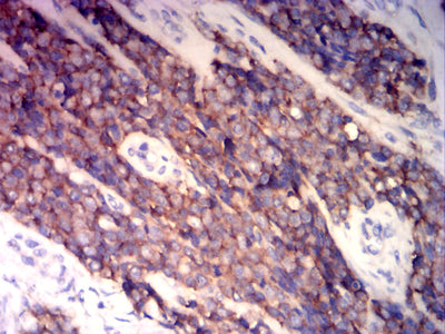 Figure 5: Immunohistochemical analysis of paraffin-embedded ewing sarcoma tissues using CD99 mouse mAb with DAB staining.