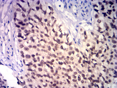 Figure 7: Immunohistochemical analysis of paraffin-embedded bladder cancer tissues using GATA3 mouse mAb with DAB staining.