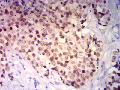 Figure 7: Immunohistochemical analysis of paraffin-embedded bladder cancer tissues using GATA3 mouse mAb with DAB staining.