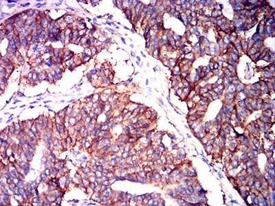 Figure 5: Immunohistochemical analysis of paraffin-embedded ovarian cancer tissues using CD147 mouse mAb with DAB staining.
