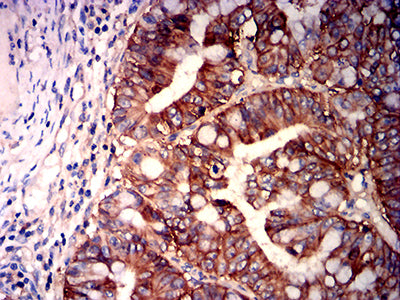 Figure 6: Immunohistochemical analysis of paraffin-embedded rectum cancer tissues using CD147 mouse mAb with DAB staining.