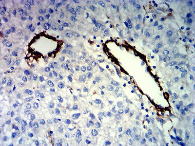 Figure 5: Immunohistochemical analysis of paraffin-embedded liver cancer tissues using FLI1 mouse mAb with DAB staining.