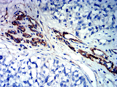 Figure 6: Immunohistochemical analysis of paraffin-embedded bladder cancer tissues using FLI1 mouse mAb with DAB staining.