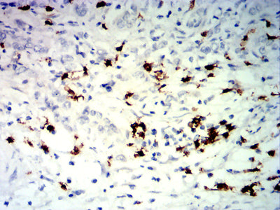 Figure 6: Immunohistochemical analysis of paraffin-embedded stomach cancer tissues using TNFRSF25 mouse mAb with DAB staining.