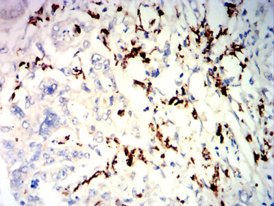 Figure 5: Immunohistochemical analysis of paraffin-embedded rectal cancer tissues using CD57 mouse mAb with DAB staining.