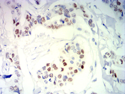 Figure 6: Immunohistochemical analysis of paraffin-embedded breast cancer tissues using PGR mouse mAb with DAB staining.