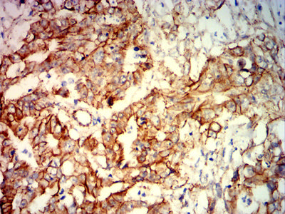 Figure 8: Immunohistochemical analysis of paraffin-embedded rectal cancer tissues using CTNNB1 mouse mAb with DAB staining.