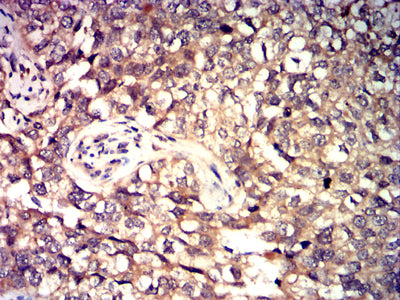 Figure 3: Immunohistochemical analysis of paraffin-embedded bladder Cancer tissues using TP63 mouse mAb with DAB staining.