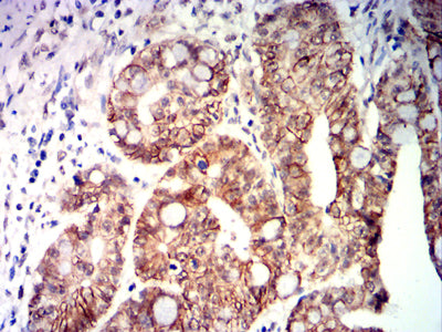 Figure 8: Immunohistochemical analysis of paraffin-embedded rectal cancer tissues using CDX2 mouse mAb with DAB staining.