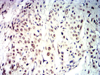Figure 7: Immunohistochemical analysis of paraffin-embedded esophageal cancer tissues using CDX2 mouse mAb with DAB staining.