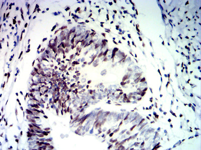 Figure 8: Immunohistochemical analysis of paraffin-embedded rectal cancer tissues using CDX2 mouse mAb with DAB staining.