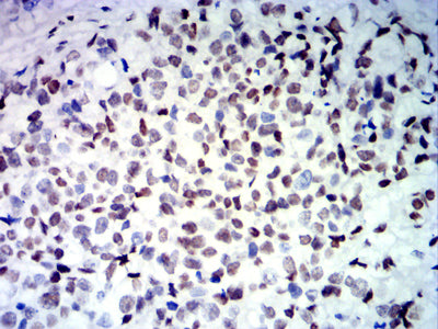Figure 6: Immunohistochemical analysis of paraffin-embedded bladder Cancer tissues using CDX2 mouse mAb with DAB staining.