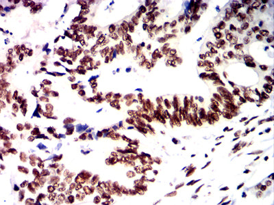 Figure 8: Immunohistochemical analysis of paraffin-embedded rectal cancer tissues using PMS2 mouse mAb with DAB staining.
