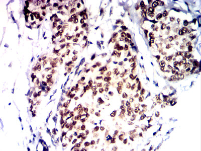 Figure 7: Immunohistochemical analysis of paraffin-embedded bladder cancer tissues using PMS2 mouse mAb with DAB staining.