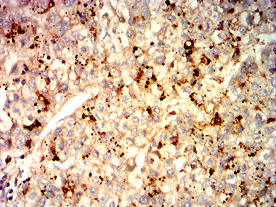 Figure 5: Immunohistochemical analysis of paraffin-embedded liver cancer tissues using GPC3 mouse mAb with DAB staining.