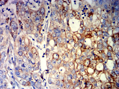 Figure 6: Immunohistochemical analysis of paraffin-embedded liver cancer tissues using CCND1 mouse mAb with DAB staining.