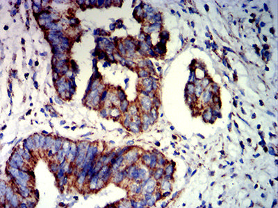 Figure 7: Immunohistochemical analysis of paraffin-embedded rectum cancer tissues using PAX8 mouse mAb with DAB staining.