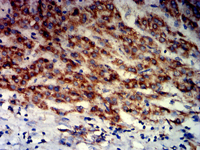 Figure 6: Immunohistochemical analysis of paraffin-embedded liver cancer tissues using PAX8 mouse mAb with DAB staining.