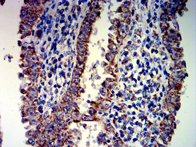 Figure 7: Immunohistochemical analysis of paraffin-embedded endometrial cancer tissues using PAX8 mouse mAb with DAB staining.