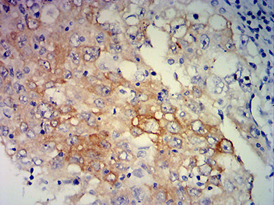Figure 6: Immunohistochemical analysis of paraffin-embedded lung cancer tissues using ERCC1 mouse mAb with DAB staining.