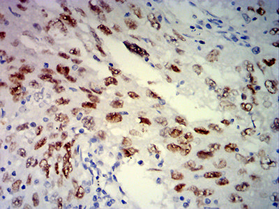 Figure 6: Immunohistochemical analysis of paraffin-embedded lung cancer tissues using MSH6 mouse mAb with DAB staining.