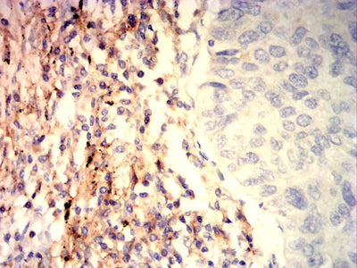 Figure 5: Immunohistochemical analysis of paraffin-embedded lung cancer tissues using CD328 mouse mAb with DAB staining.