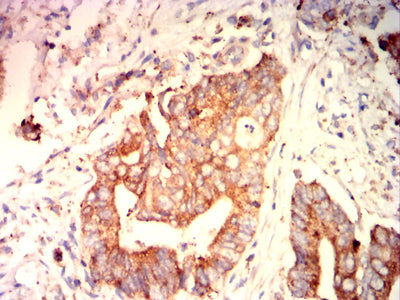 Figure 6: Immunohistochemical analysis of paraffin-embedded rectal cancer tissues using TSLPR mouse mAb with DAB staining.